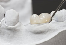 a same-day dental crown being constructed on a mold 