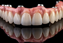 Example of an implant denture from Renu Dental