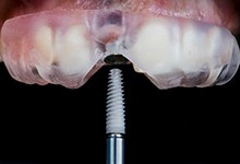 Close-up of dental implant being inserted into jawbone