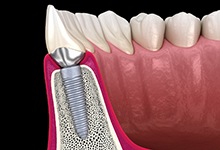 Side view of dental implant integrated with surrounding bone