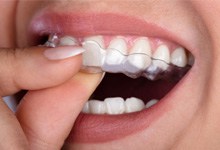 : a person wearing SureSmile clear aligners 