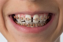 Person with gap and braces in Crookston 
