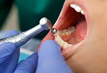 Close-up of patient’s mouth during polishing part of dental cleaning