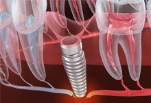 Illustration of a failed dental implant in Crookston, MN