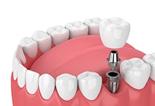 single tooth dental implant 