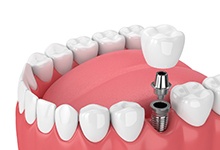 Animated dental implant supported dental crown placement