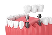 Animated dental implant supported fixed bridge placement