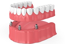 Animated dental implant supported denture placement