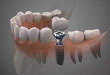 Diagram of a dental implant placed in the jaw 