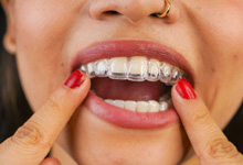 a patient wearing their Spark clear aligner