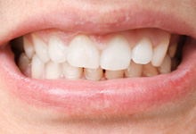 a close-up of a patient with an overbite
