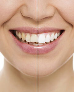Smile before and after cosmetic dentistry