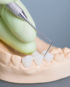 Model smile used to prepare restoration prior to restorative dentistry visit