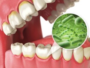 open mouth showing gum disease