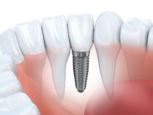 Dental implant in the lower jaw
