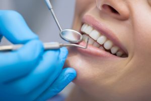 Woman’s smile after dental bonding in Crookston