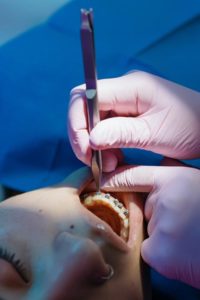 Gloved hands applying braces on teeth