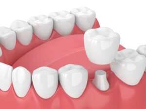 Animated model of dental crown.