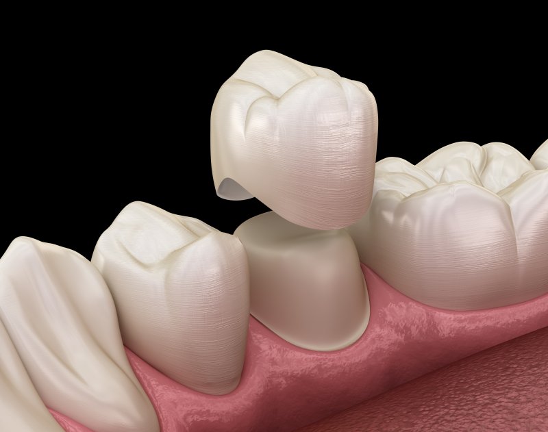 A 3D illustration of a prepared tooth receiving a dental crown